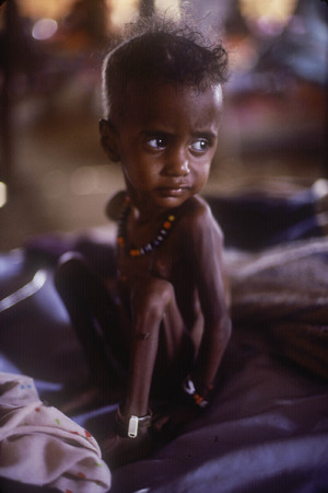 Eastern Sudan:
Famine victim at Wad Shirife refugee camp.